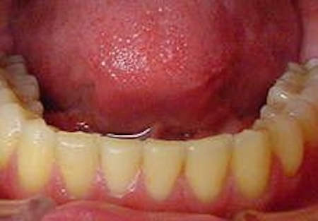 【矯正症例】ディープバイト、睡眠時無呼吸症候群が疑われた症例